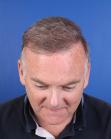 After Hair Transplant&nbsp;2 Sessions (Areas)